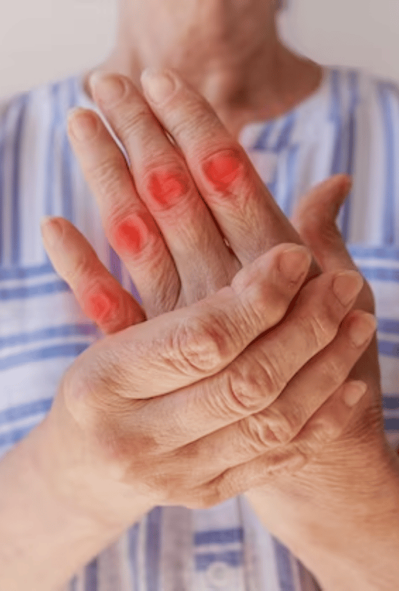 Rheumatoid therapy